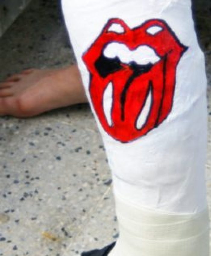 Gipsbein mit Rolling Stones Zunge